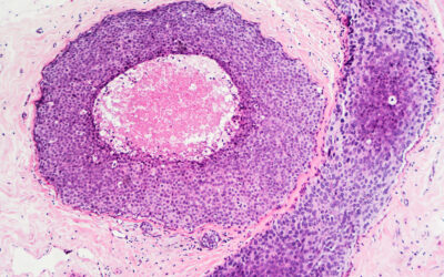 Breast cancer - ductal carcinoma in situ (DCIS): Tumor cells are confined to the mammary ducts. No invasion is seen (photographed and uploaded by US board certified surgical pathologist).